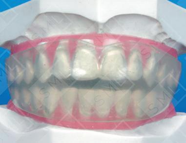 Positioner after Braces