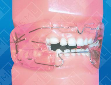 The Frankell III Dental Appliance