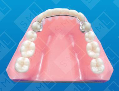 Lingual Bar (Banded or Bonded)