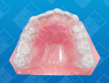 Full Palate Maxillary Bruxism Splint U