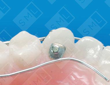 Wilson 3D Multi-Action Palatal Appliance image 2
