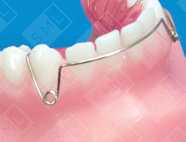 Apron Spring Labial (Roberts Retraction Arch)