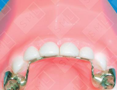 Groper Fixed Anterior Bridge- with crowns U/L
  image 2