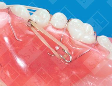 Combination Fixed/ Removable Appliance U/L, Teeth Rotating Appliance