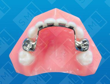 Groper Fixed Anterior Bridge- with crowns U/L
  image 1