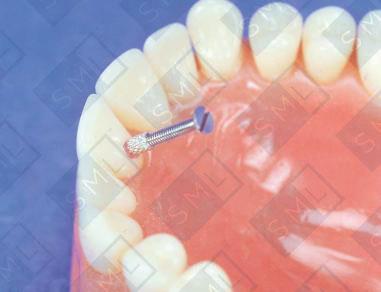 Micro-Screw Replacements image 2