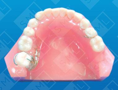 Molar Uprighting Treatment Partial
image 1