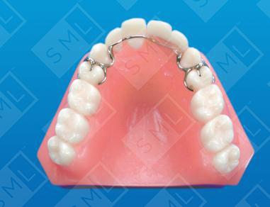 Palate-Free Temp Removable Partial Denture