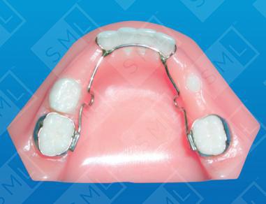 Removable Lingual U/L image 1