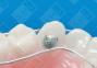 Wilson 3D Multi-Action Palatal Appliance image 2