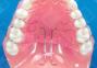 Soft Palatal Lift Appliance image 1
