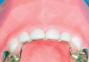Groper Fixed Anterior Bridge- with crowns U/L
  image 2