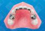 Groper Fixed Anterior Bridge- with crowns U/L
  image 1