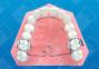 Wilson 3D Multi-Action Palatal Appliance image 1