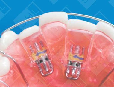 Mini Screw Appliance