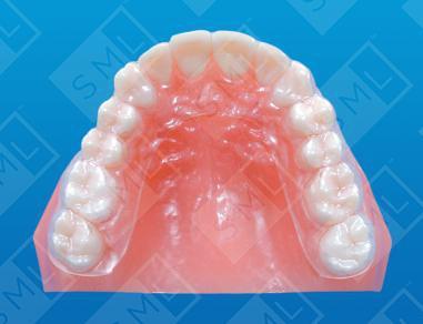 Essix Retainer