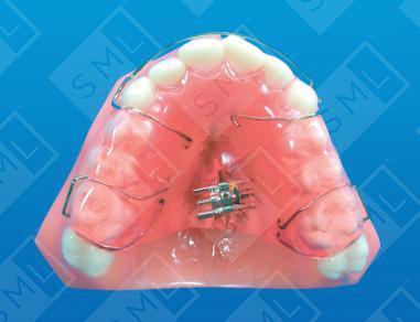 Posterior Crossbite Appliance