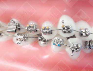 Brackets for Braces